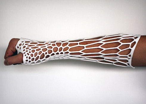 3D-печать избавит от гипса при переломах