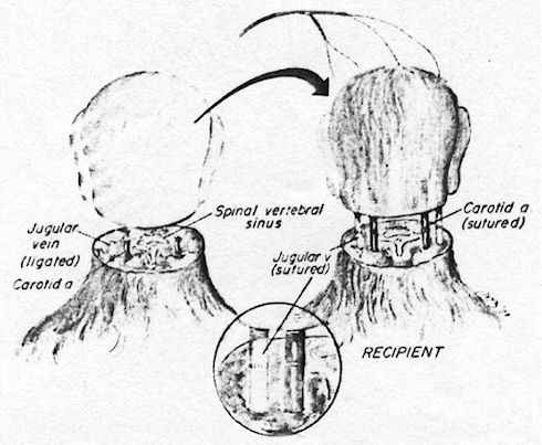 В Италии разработан метод пересадки головы человека