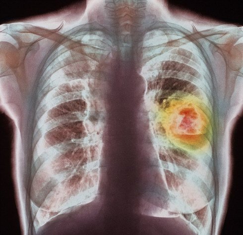 Ученые доказали, что кислород вызывает рак легких