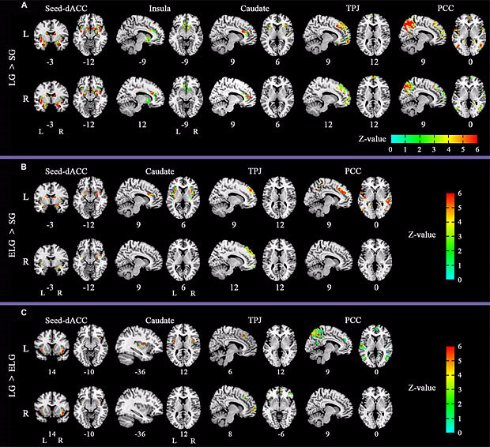 Ученые показали как выглядит мозг влюблённого человека